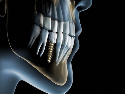 Advancements in Nanotechnology for Restorative Dentistry